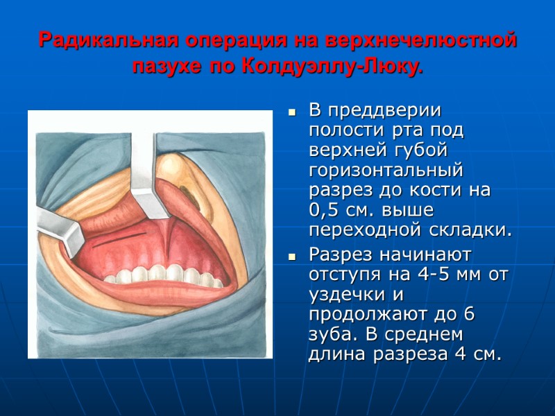 Радикальная операция на верхнечелюстной пазухе по Колдуэллу-Люку. В преддверии полости рта под верхней губой